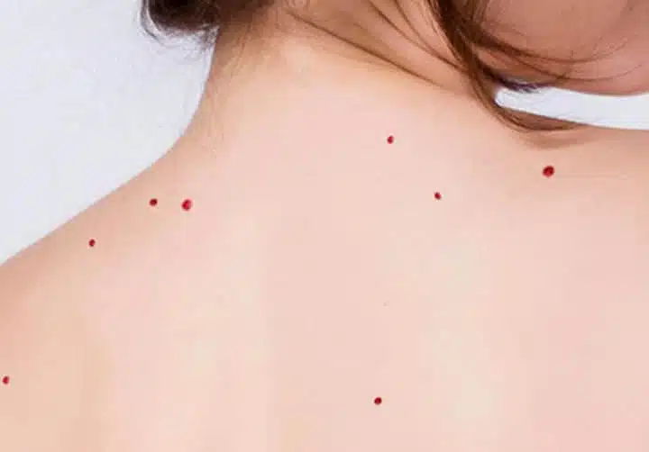 Illustration d'angiomes capillaires sur la peau