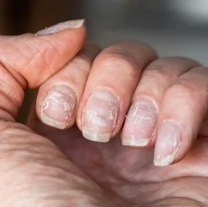 Ongles cassants dus au manque de sommeil