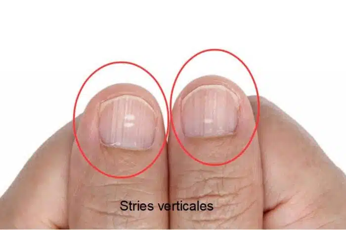 Ongles avec stries verticales