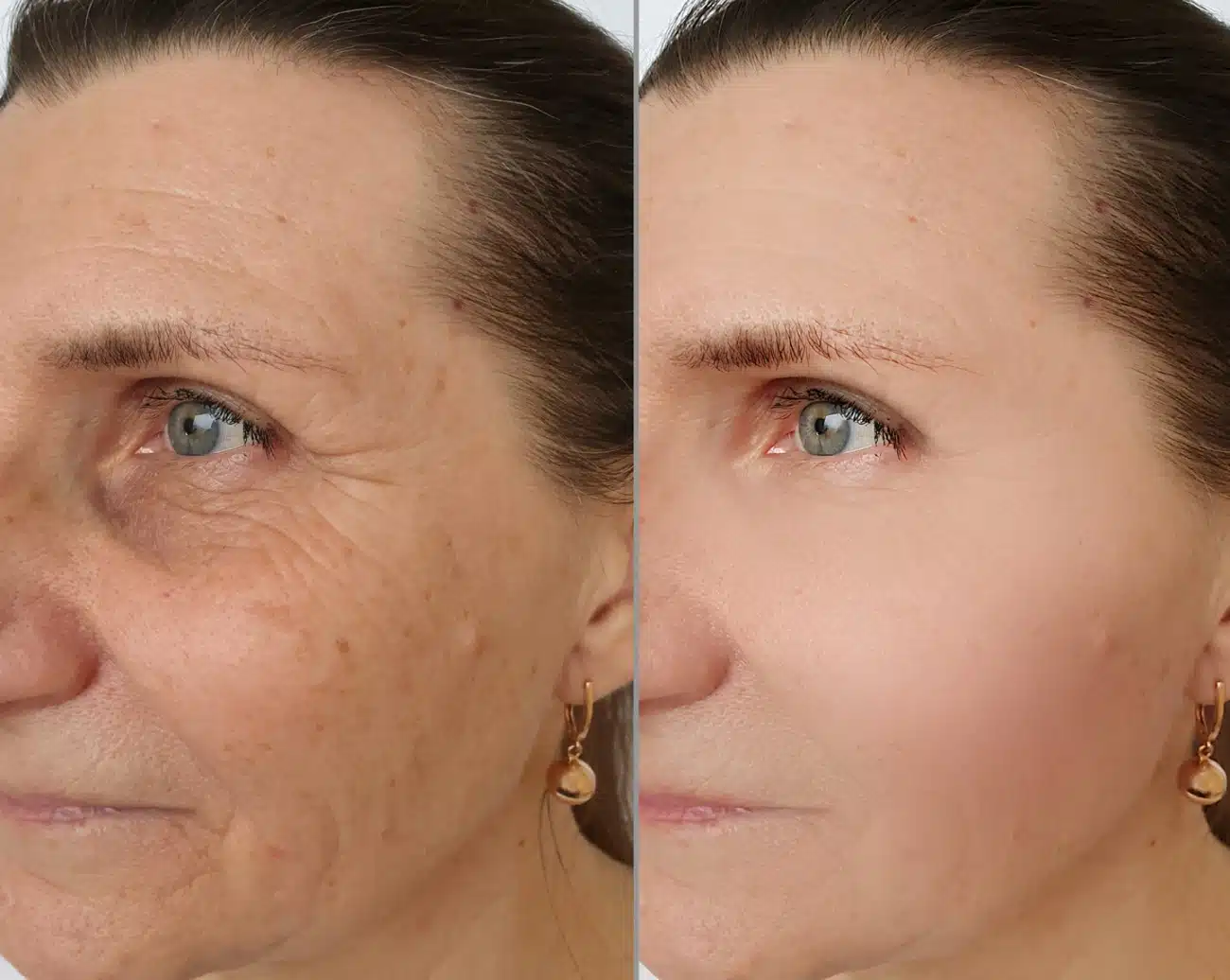 Comparaison avant/après traitement naturel de la peau