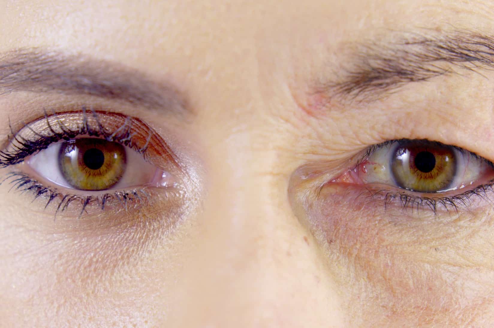 Paupière tombante (ptosis)