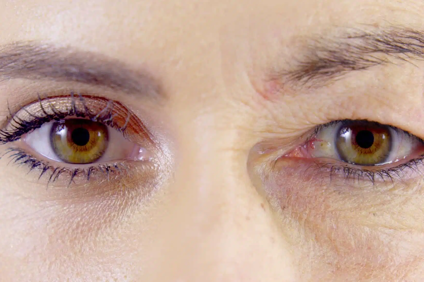 Paupière tombante (ptosis)