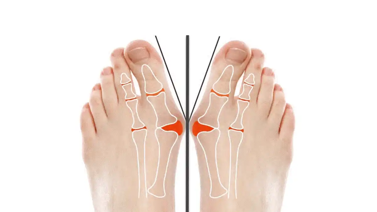 Solutions contre les oignons de pied