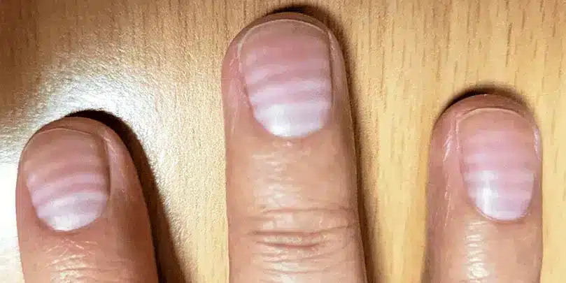 Ongles avec lignes horizontales