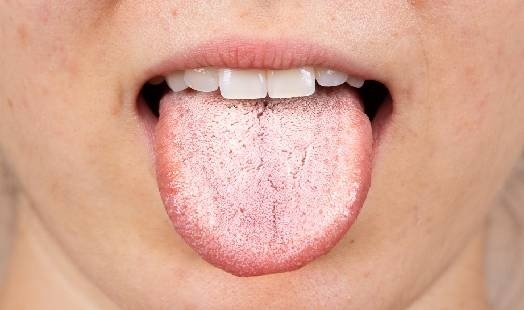 Langue recouverte d'un dépôt blanc