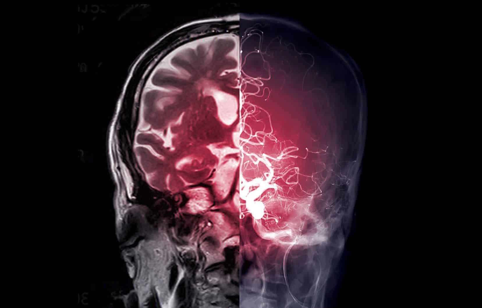 Illustration d'un cerveau humain