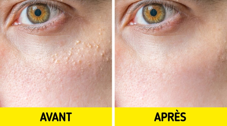 Traitement dermatologique des miliums