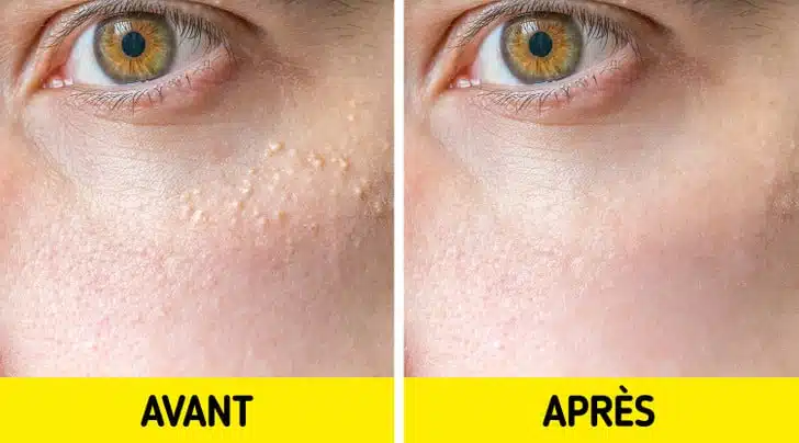 Illustration de grains de milium sur la peau