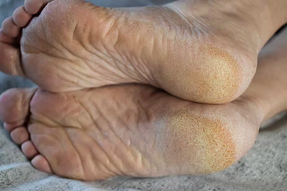 Pieds présentant une teinte jaunâtre