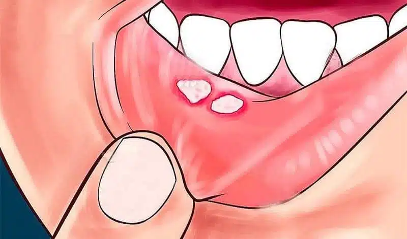 Aphte dans la bouche
