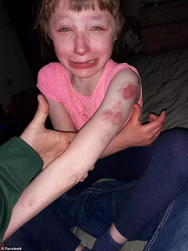 Ces parents étaient furieux lorsqu’ils ont appris que leur fille handicapée a été mordue dans l’autobus scolaire