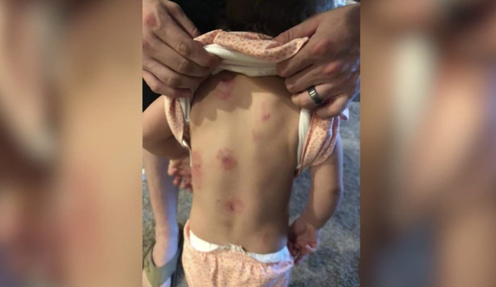 Des parents demandent des explications apr&egrave;s avoir d&eacute;couvert des traces de coup sur leur enfant