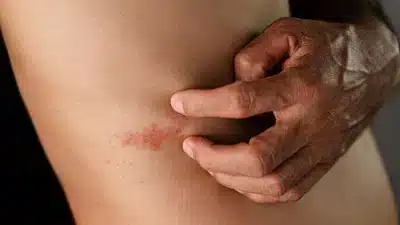 Précautions à prendre avec le zona
