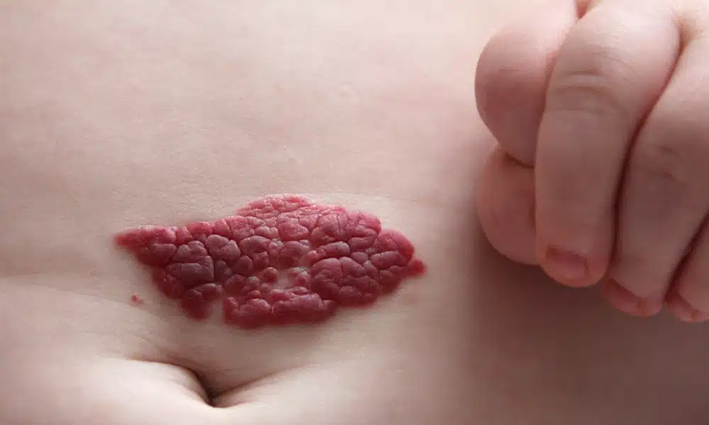Hémangiome sur la peau