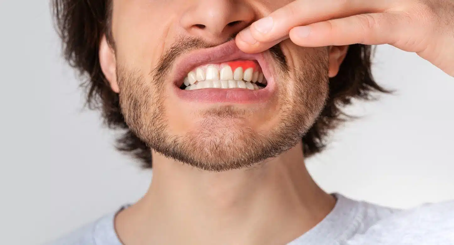 Bouche avec inflammation des gencives