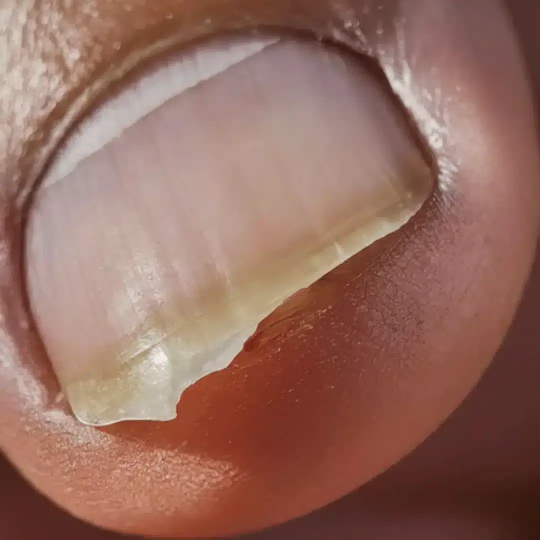 Ongles de pieds pâles et abîmés