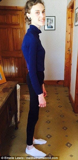 Une jeune fille anorexique montre des photos avant et apr&egrave;s sa gu&eacute;rison et elle est devenue tr&egrave;s jolie