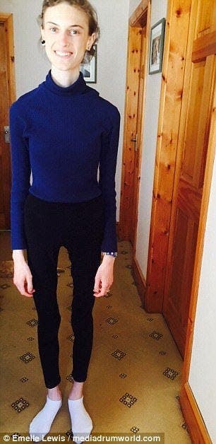 Une jeune fille anorexique montre des photos avant et apr&egrave;s sa gu&eacute;rison et elle est devenue tr&egrave;s jolie