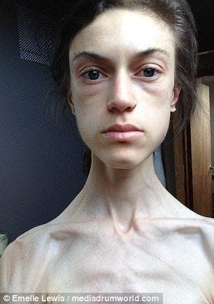 Une jeune fille anorexique montre des photos avant et apr&egrave;s sa gu&eacute;rison et elle est devenue tr&egrave;s jolie