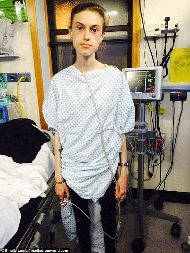 Une jeune fille anorexique montre des photos avant et apr&egrave;s sa gu&eacute;rison et elle est devenue tr&egrave;s jolie