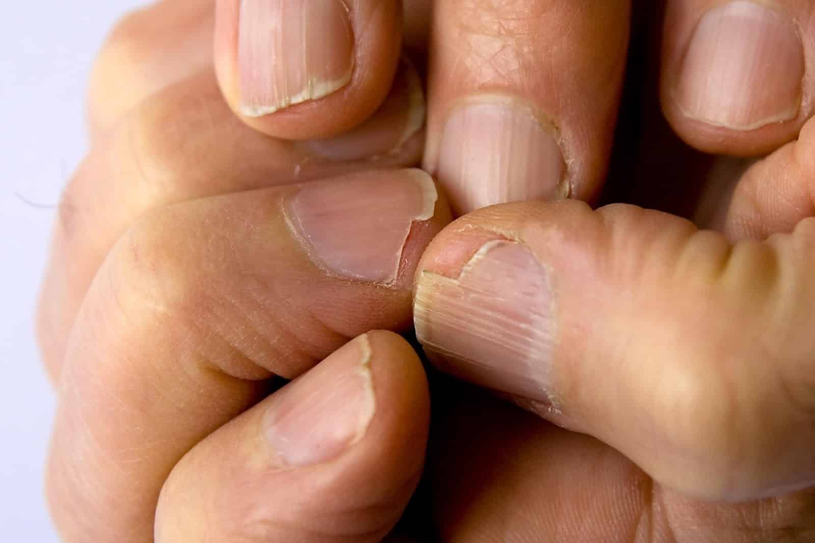 Ongles cassants et soins nutritionnels