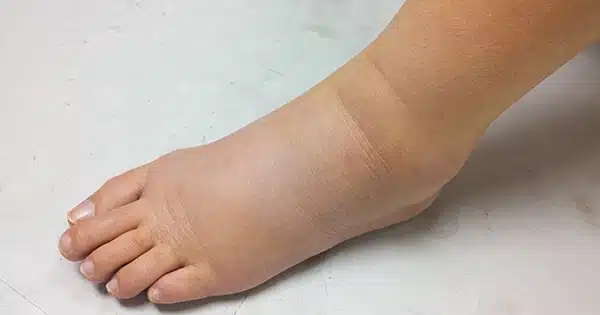Œdème des jambes