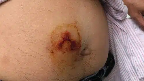 Réaction cutanée due aux punaises