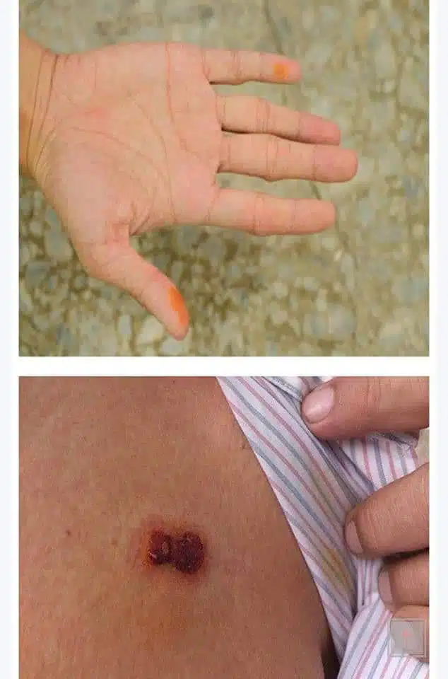 Soin d'une irritation cutanée