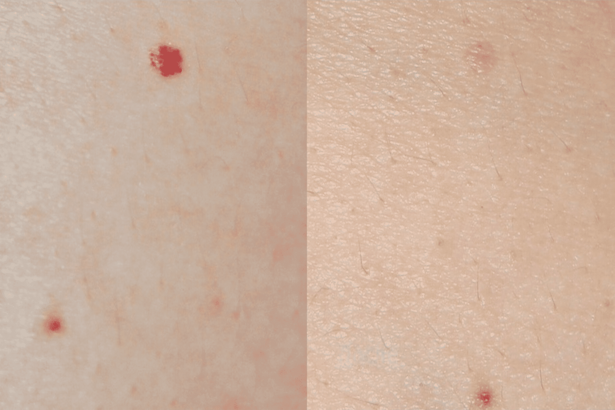 Comparaison avant/après traitement d'angiome