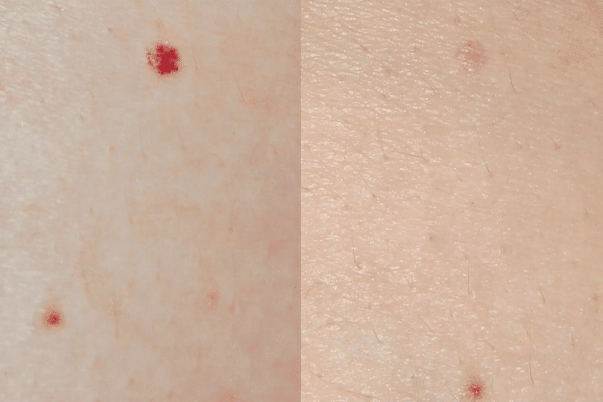 Comparaison avant/après traitement d'angiome