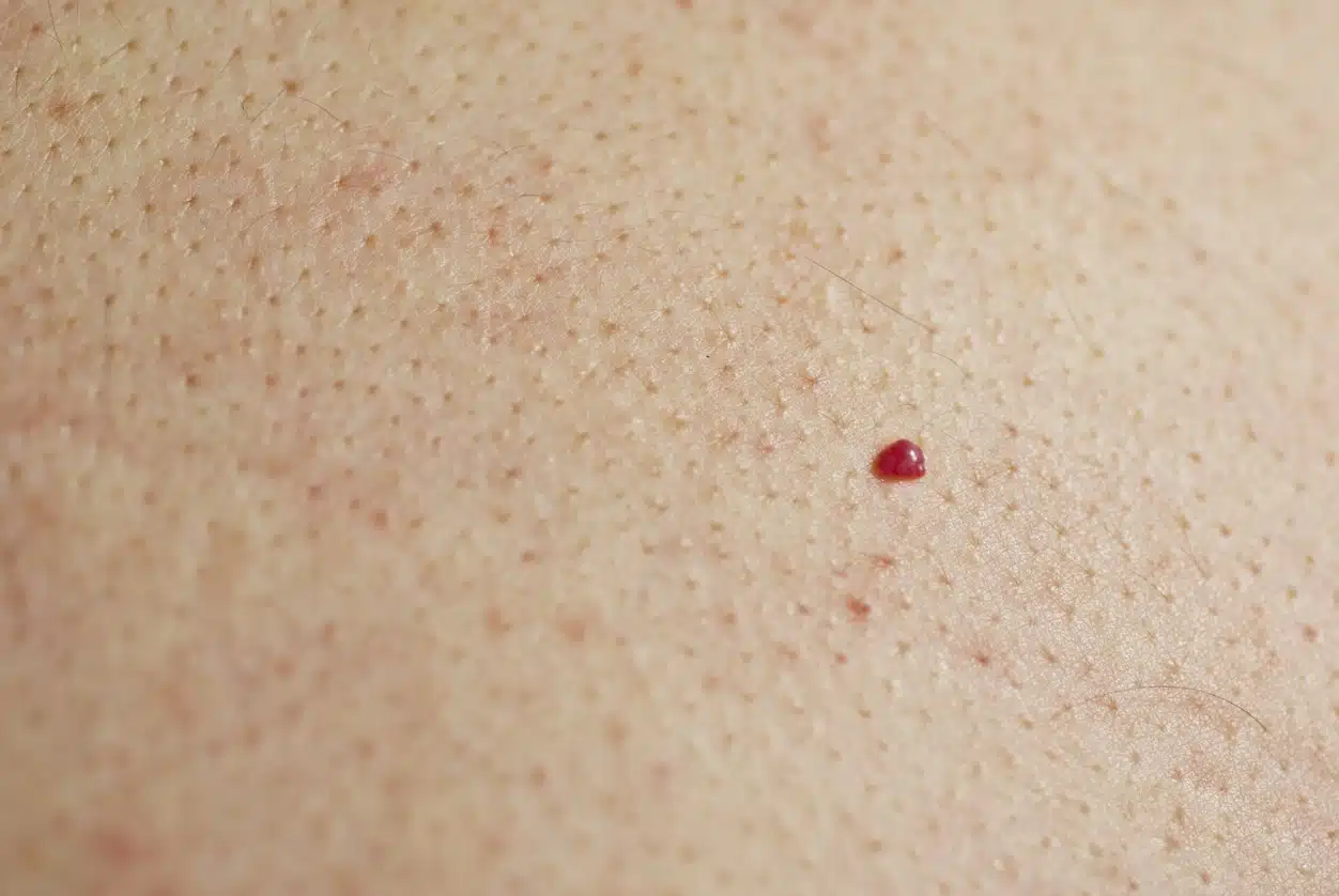 Angiome cerise sur la peau