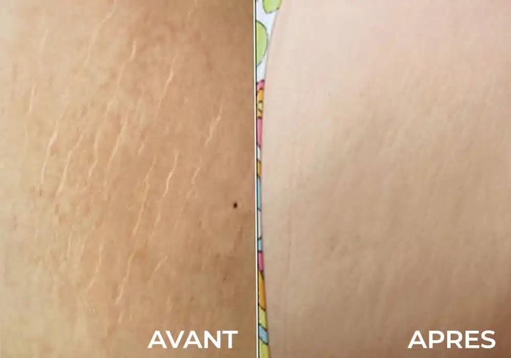 Comparaison avant/après traitement des vergetures