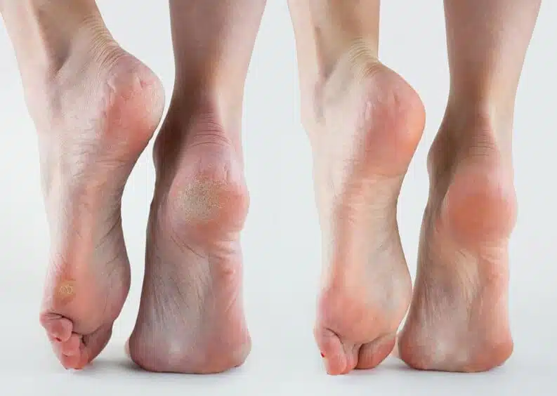Soin des pieds