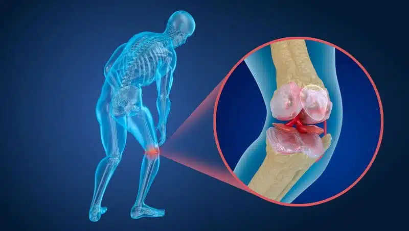 Ostéoporose et soins chiropratiques