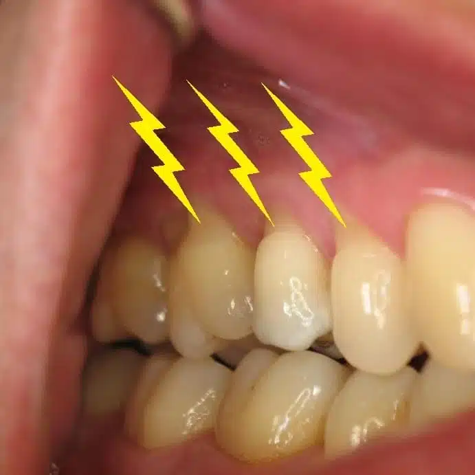Dents présentant des signes de fragilité