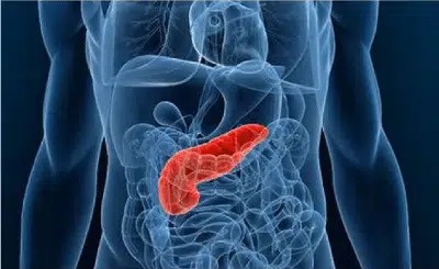 Schéma d'un cancer du pancréas