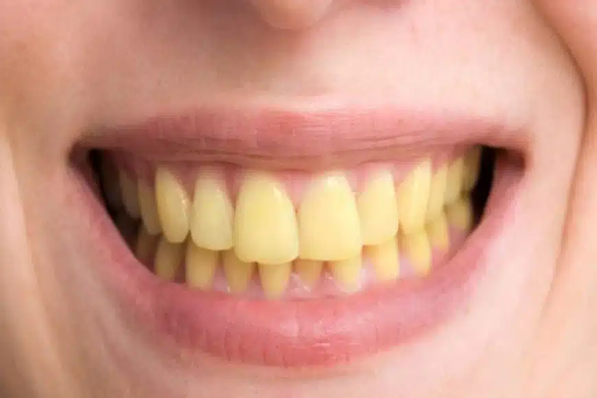 Dents avant et après traitement naturel