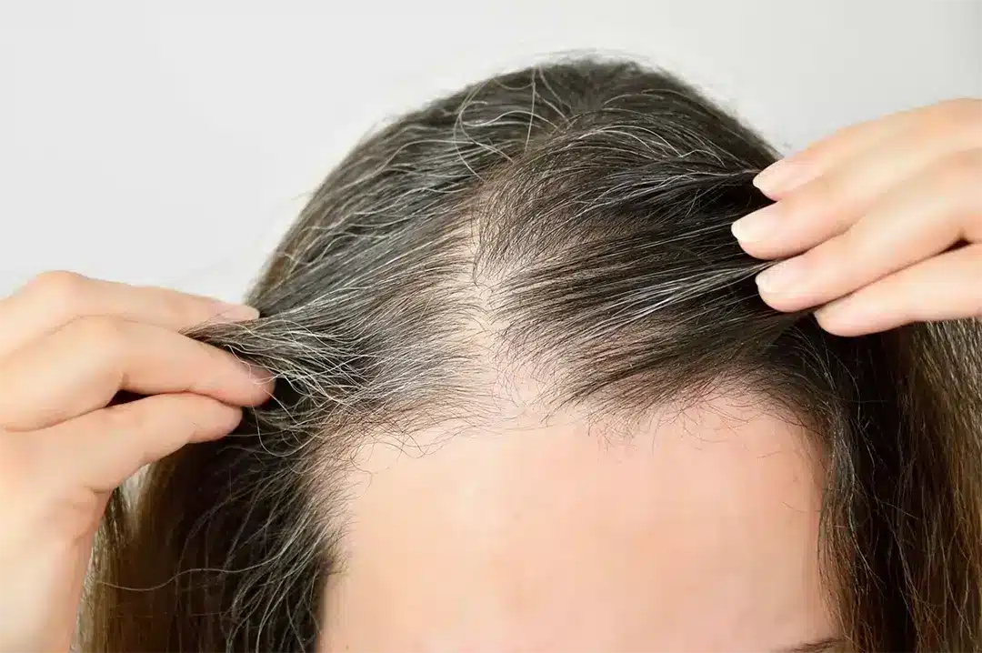 Cheveux blancs et vieillissement capillaire