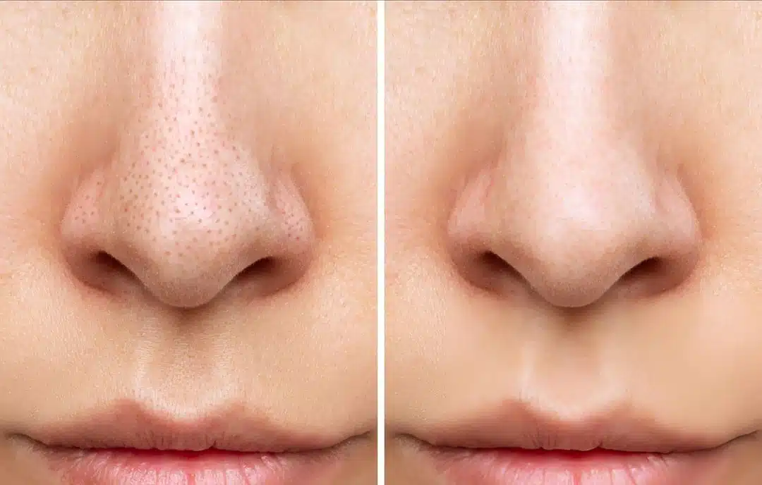 Masque au miel pour la peau