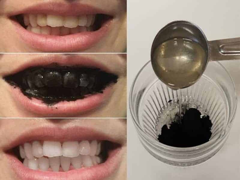 Dents blanches grâce au charbon actif
