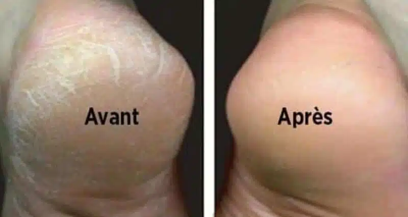 Pieds bien hydratés après traitement à l'avocat
