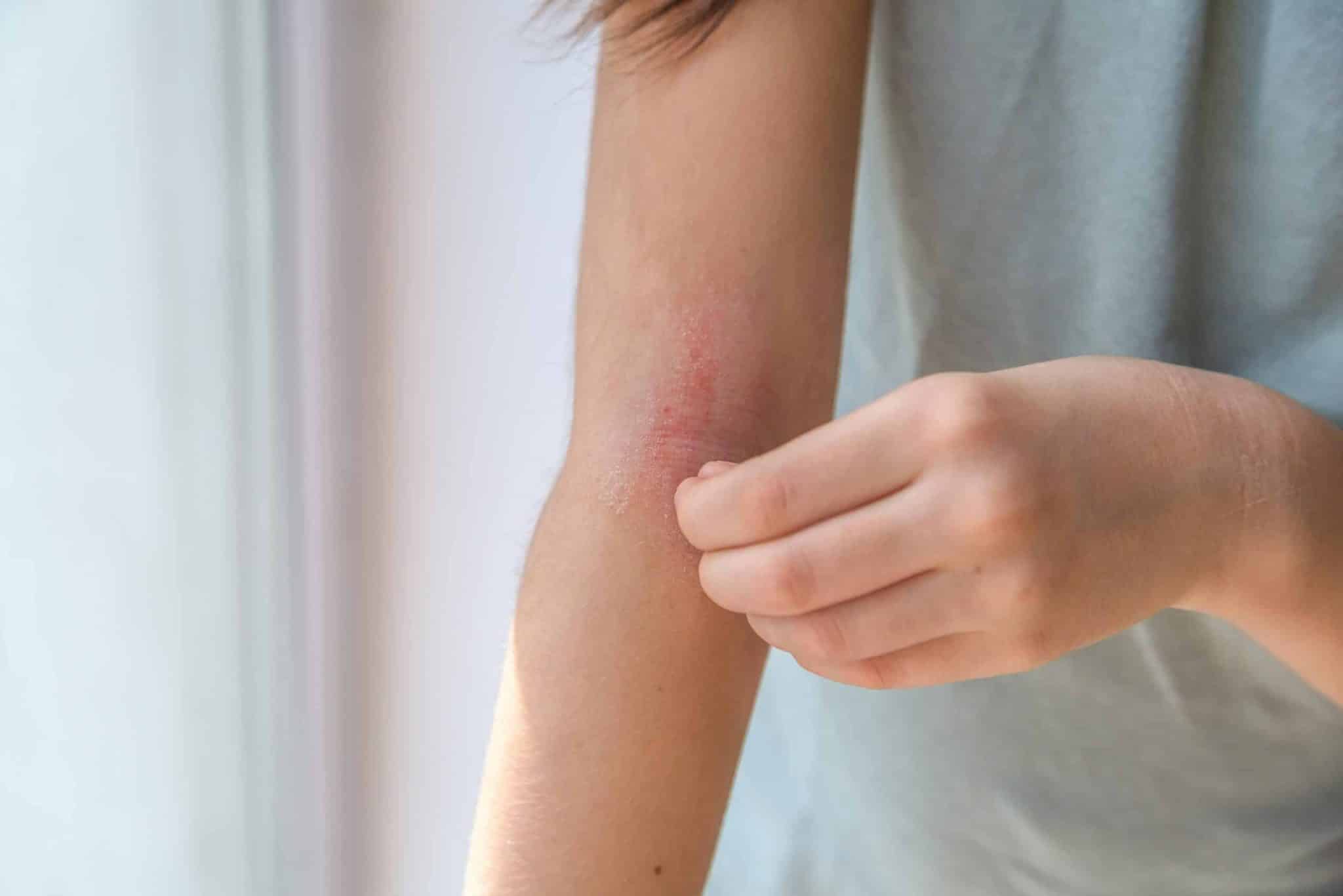Enfant souffrant d'eczéma sur le bras