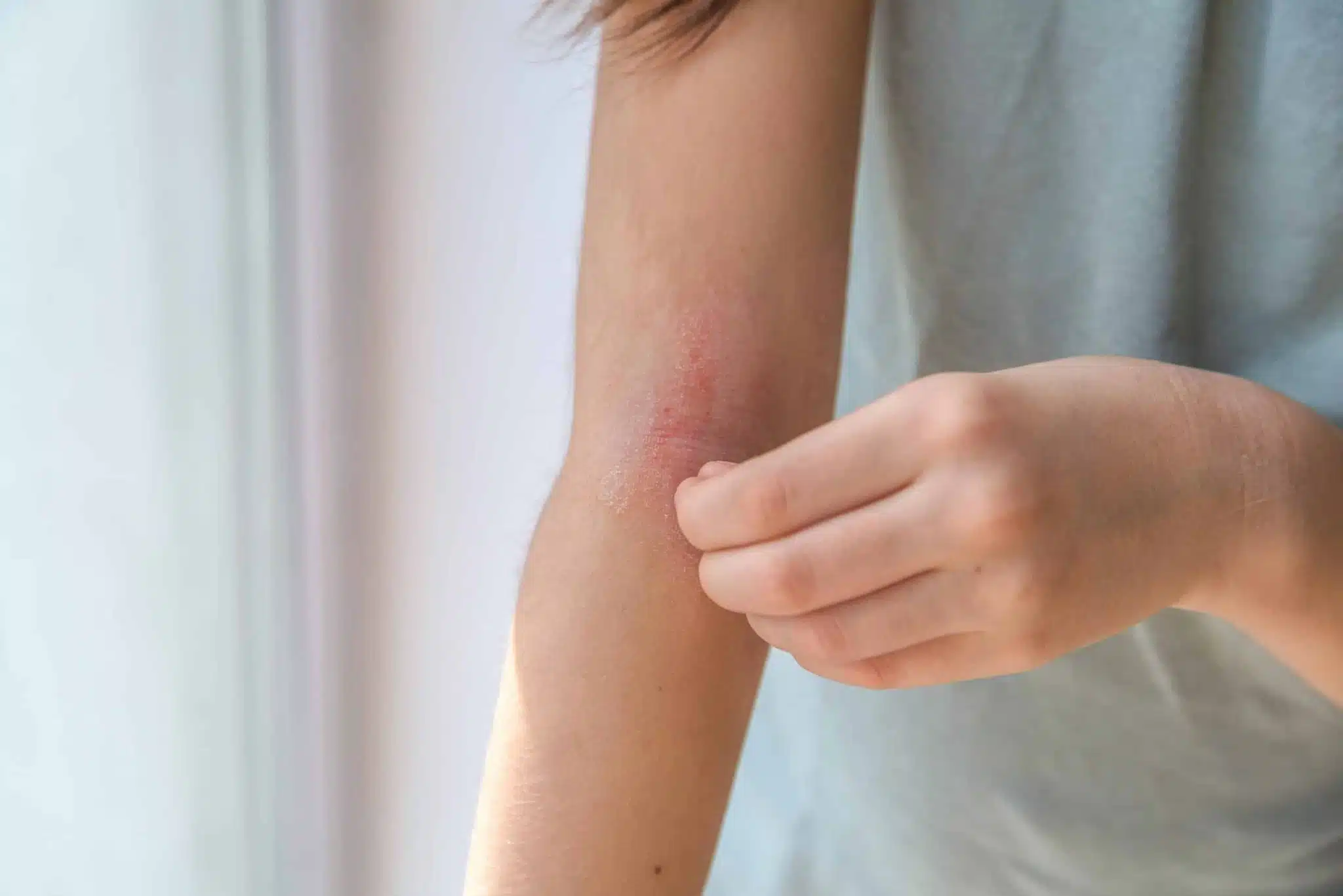 Enfant souffrant d'eczéma sur le bras