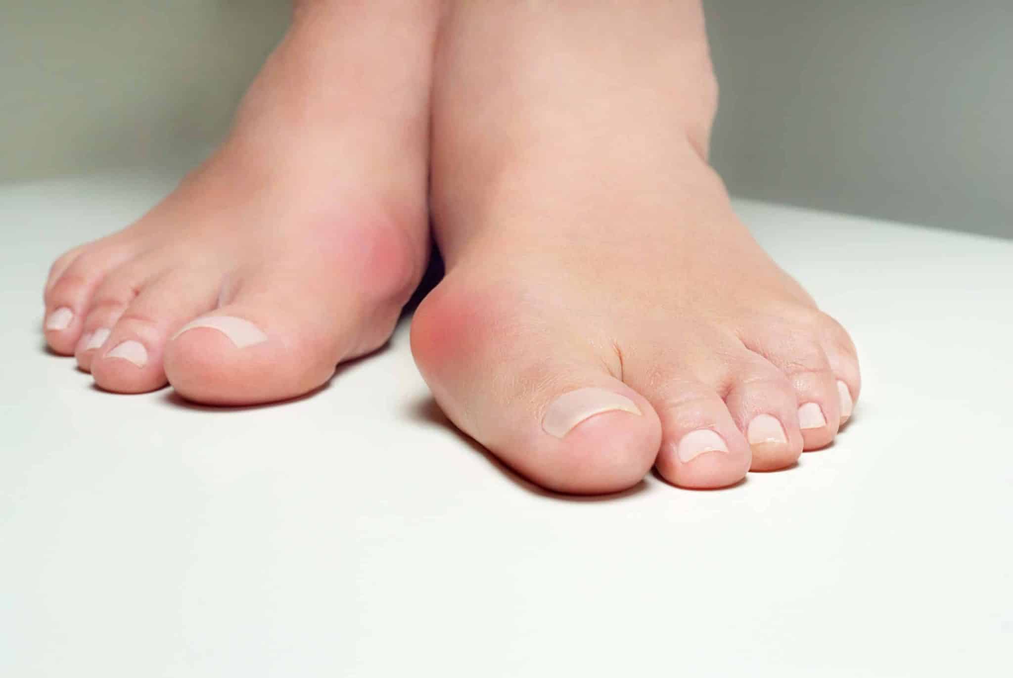 Hallux valgus - déformation du pied