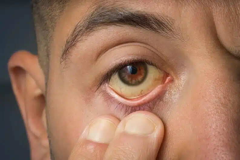 Homme observant le jaunissement de ses yeux