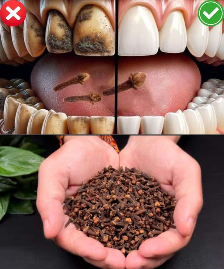 Clous de girofle, une &eacute;pice aux propri&eacute;t&eacute;s bucco-dentaires