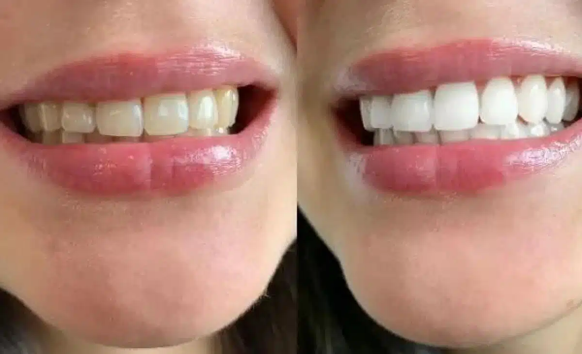 Dents blanches grâce à des solutions naturelles