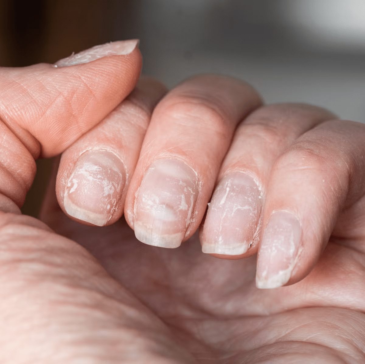 Stries verticales sur les ongles