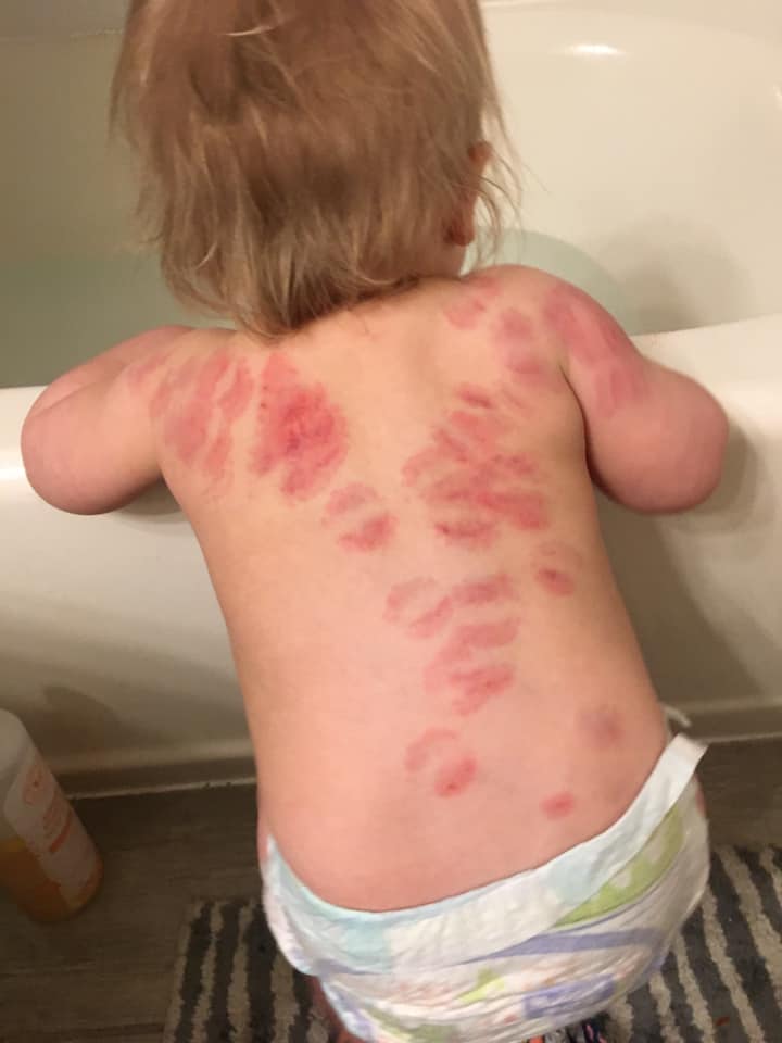 Une maman d&eacute;couvre 25 marques de morsures sur sa fille apr&egrave;s &ecirc;tre all&eacute;e la chercher &agrave; la garderie