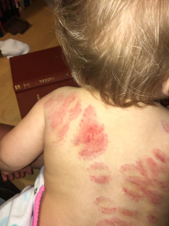 Une maman d&eacute;couvre 25 marques de morsures sur sa fille apr&egrave;s &ecirc;tre all&eacute;e la chercher &agrave; la garderie
